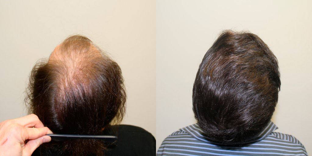 dr nusbaum hair transplant review