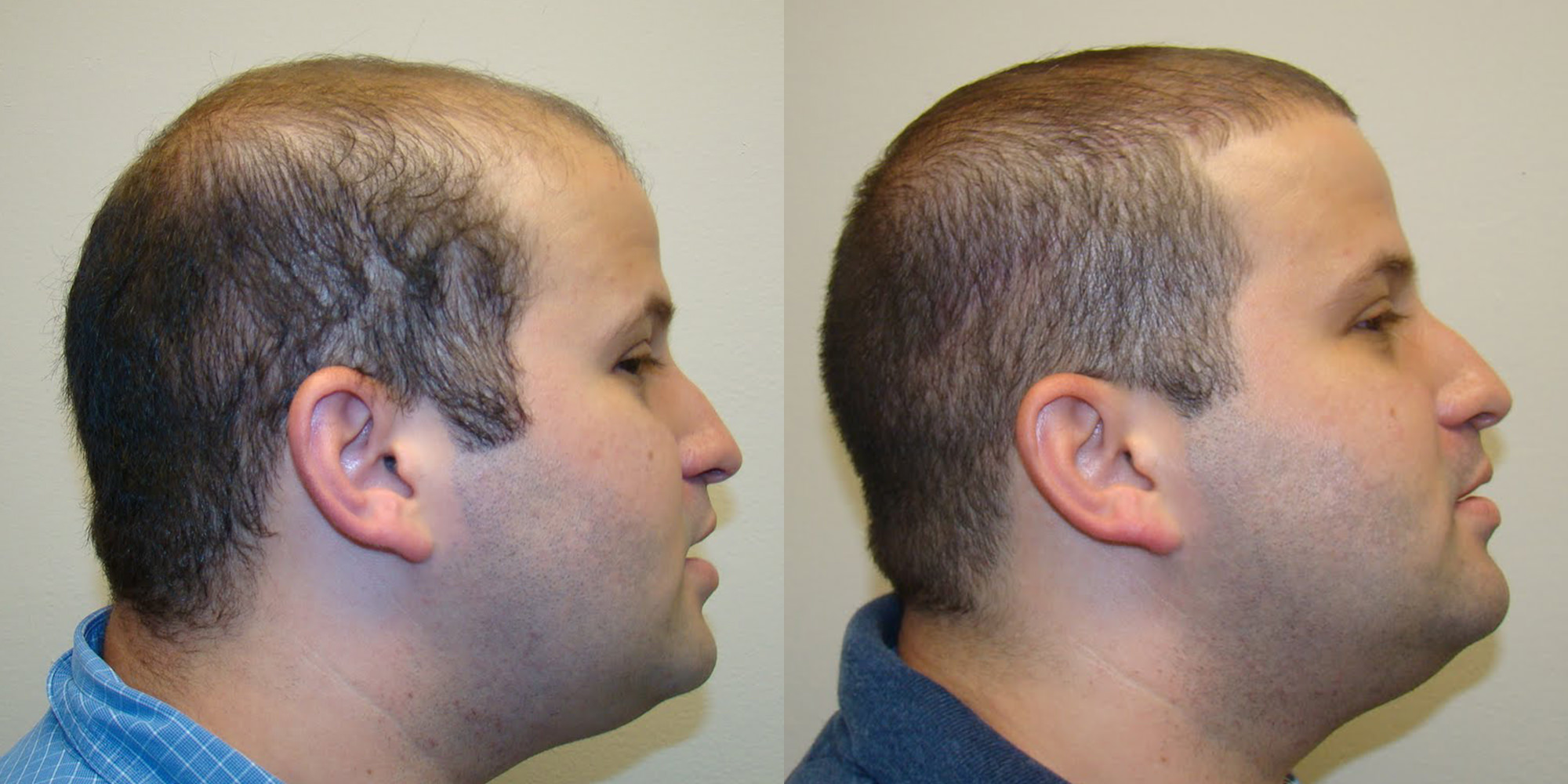 dr nusbaum hair transplant review