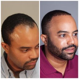 bosley hair restoration cost reviews