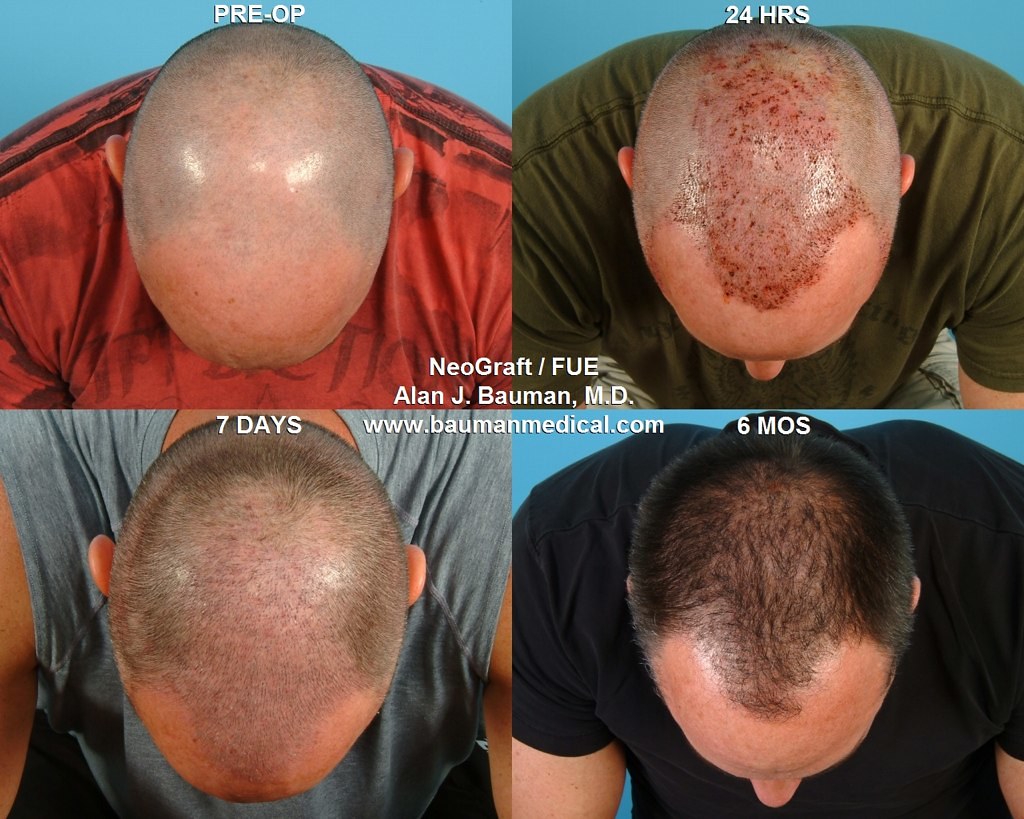 bosley hair restoration cost reviews