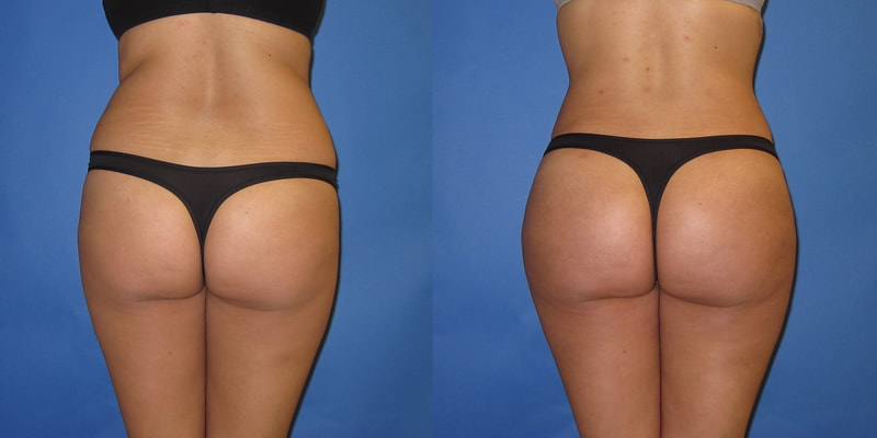 brazilian butt lift surgery reviews and photos