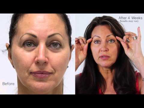 beverly hills md deep wrinkle filler reviews