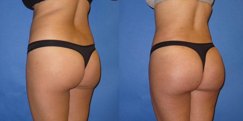 brazilian butt lift surgery reviews and photos