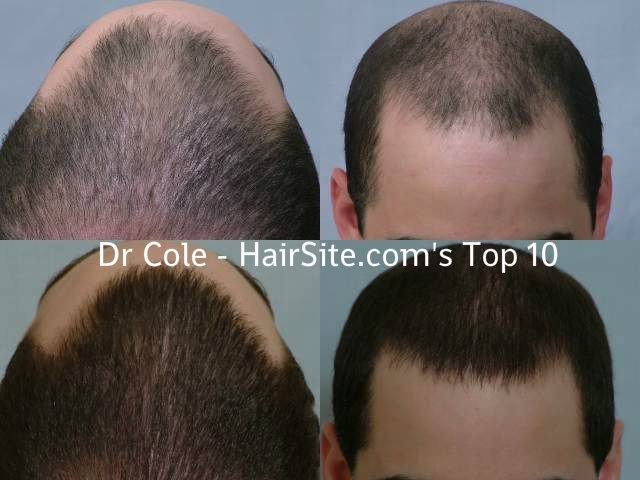 dr nusbaum hair transplant review