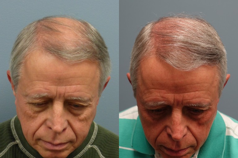 dr nusbaum hair transplant review